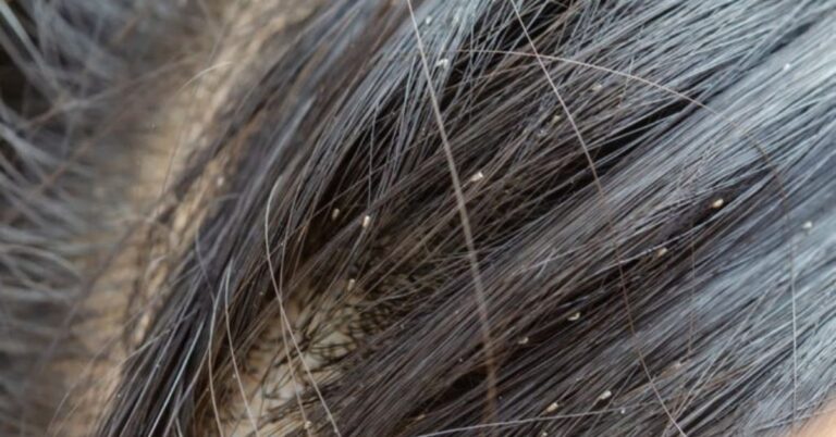 10-cach-tri-chay-don-gian-hieu-qua-an-toan-tai-nha-cho-be-va-nguoi-lon-12