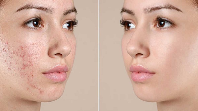 cac-buoc-skincare-cho-da-mun-10