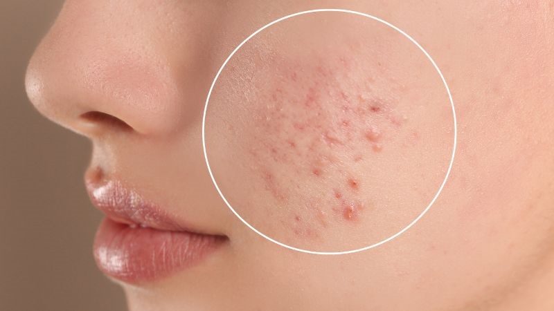 cac-buoc-skincare-cho-da-mun-3