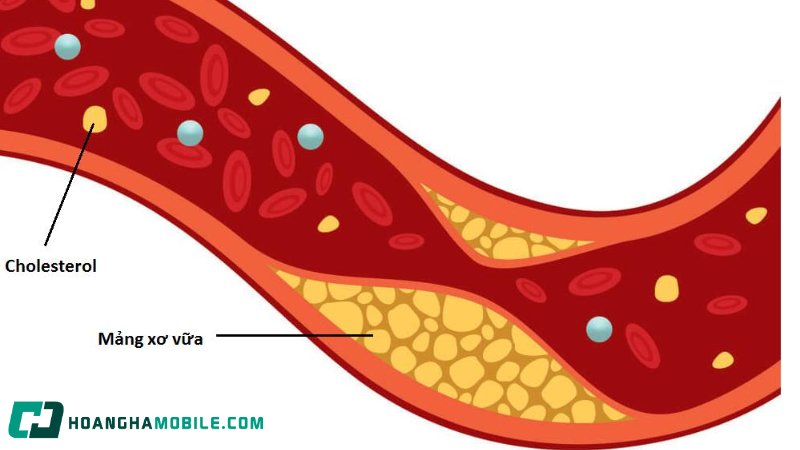 cholesterol-la-gi-1